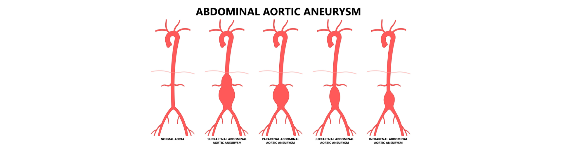 Ανεύρυσμα κοιλιακής αορτής