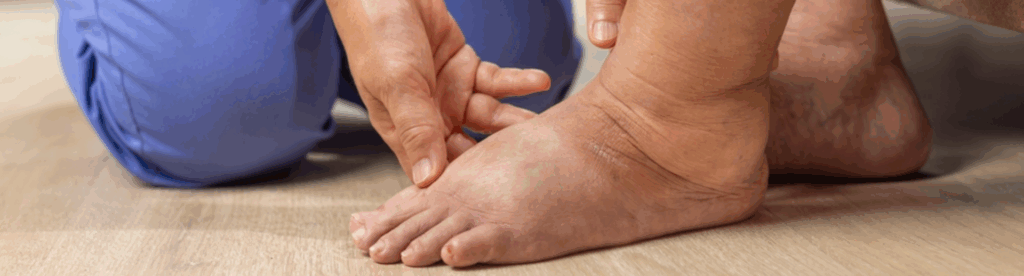 Λεμφοίδημα