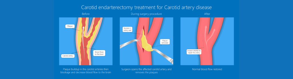 Ενδαρτηρεκτομή καρωτίδων